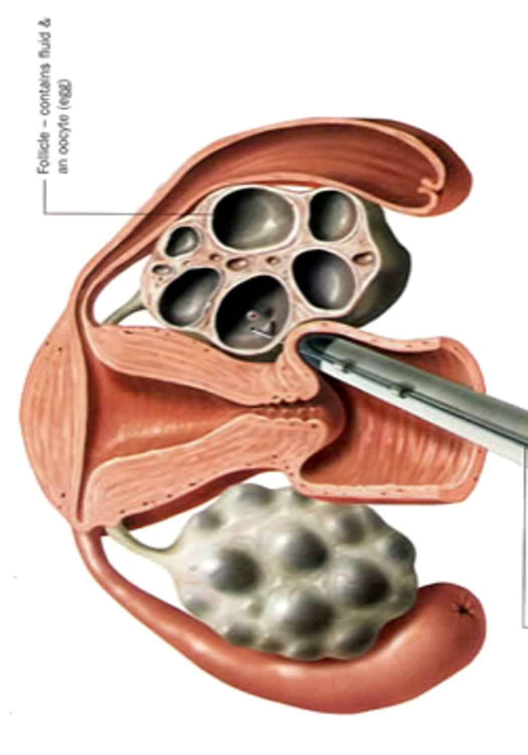 follicle aspiration oocyte retrieval