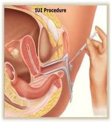 IUI Procedure