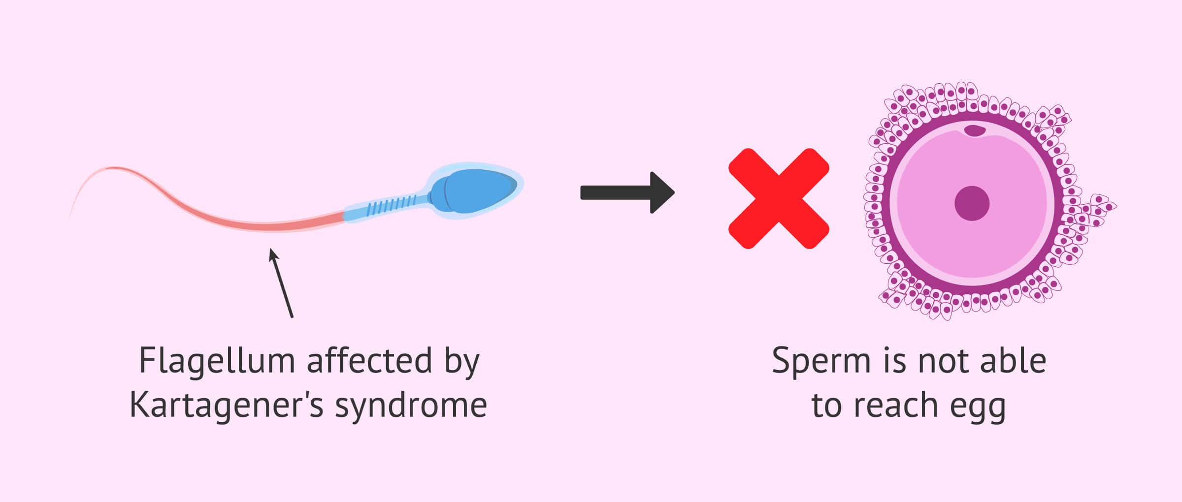 Kartagener syndrome