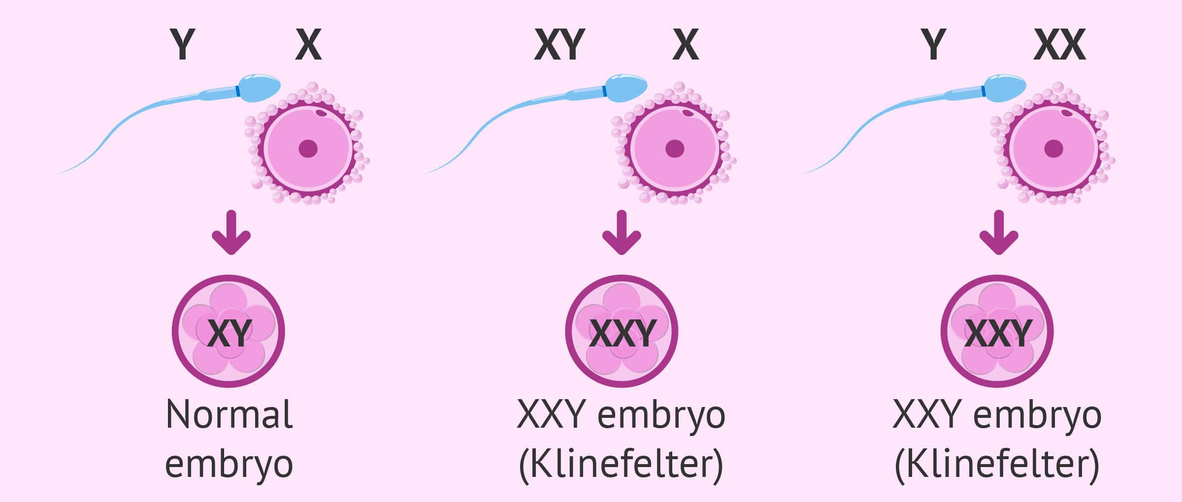 Klinefelter Syndrome