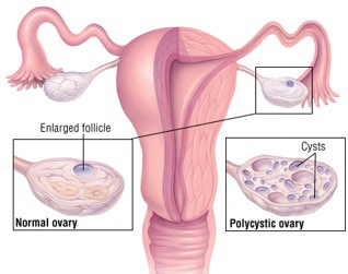 pcos