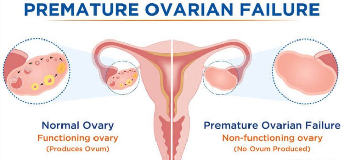 Premature Ovarian Failure