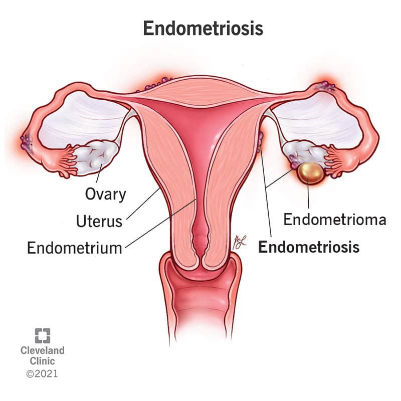 Endometriosis